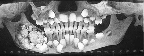 Odontoma | Dental, Dentaltown, Dental facts