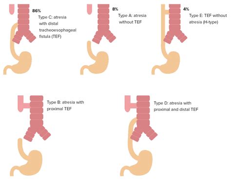 Esophageal Atresia Types