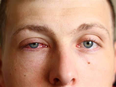 The Scoop on Pink Eye: Prevention, Risk Factors & Treatments