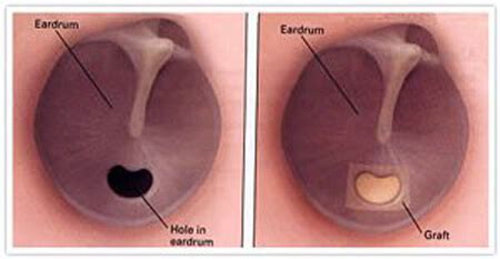 Tympanoplasty – Korum ENT