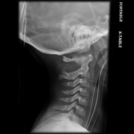 Atlanto Occipital Joint Xray