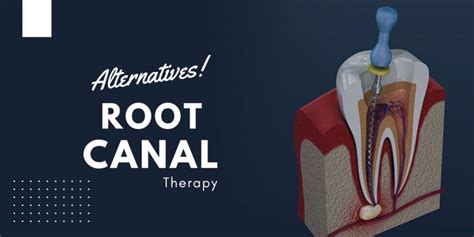 8 Alternatives To Root Canal Therapy - IdealNourishment