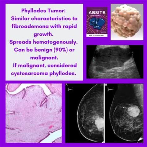 Phyllodes Tumor Growth Rate