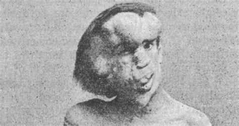 Joseph Merrick's Tragic Life As The "Elephant Man" Of Victorian England