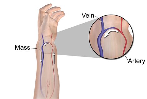 Cirugía Vascular | Concise Medical Knowledge