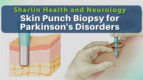 Get to Know About Skin Punch Biopsy for Alpha Synuclein Protein at ...