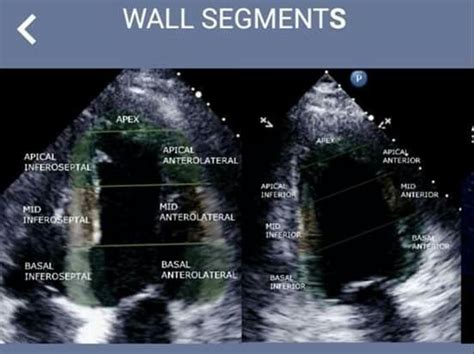 Pin by Natalie B on Heart love in 2023 | Cardiac sonography, Diagnostic ...