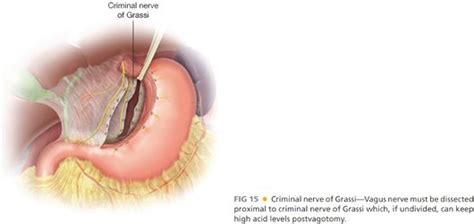 Vagotomy: Truncal and Highly Selective | Basicmedical Key