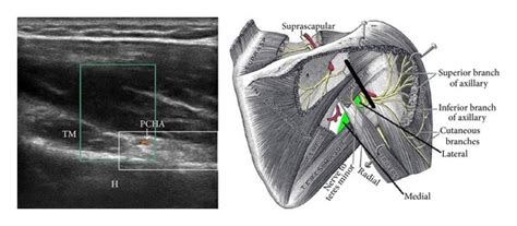 View of the quadrilateral space (white box), posterior circumflex ...