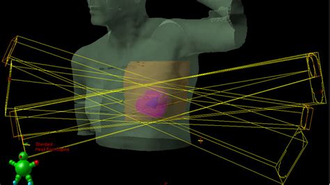 Partial Breast Radiation - All About Radiation