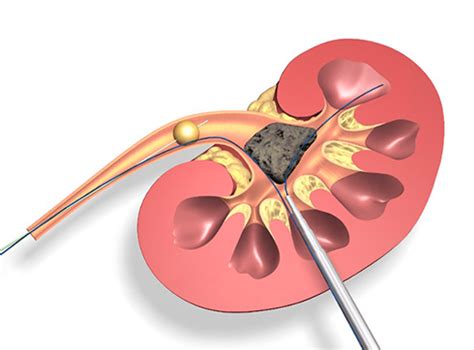 Laser Lithotripsy