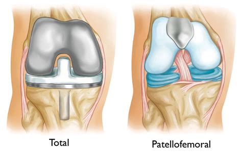 Patellofemoral joint replacement – Dr. Brook Adams, MD