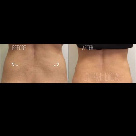 Liposuction Alternatives Treatment | Dermedica | Vanquish Fat Reduction