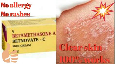 Betnovate C cream uses and side effects in telugu.Best ointment for skin allergies. - YouTube