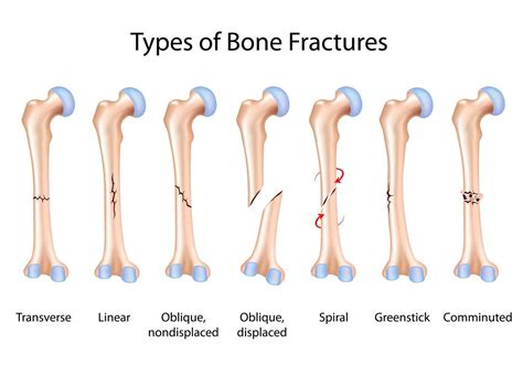 Caring for Fractures in Reno and Carson City | Swift Institute