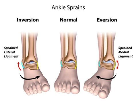 Lateral Ligament Injury - Sports Medicine Information