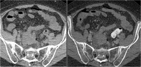 The Radiology Assistant : CT contrast injection and protocols