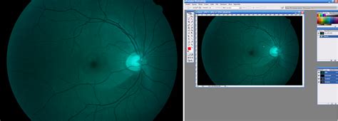 Nerve Fiber Layer Defects Imaging in Glaucoma | IntechOpen