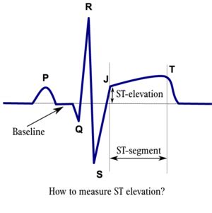 Myocardial Infarction - ECGpedia