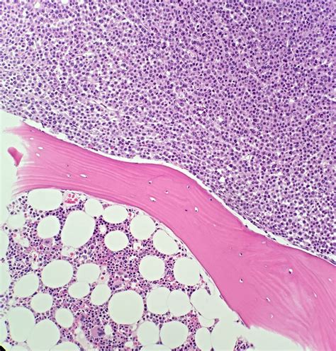 Bone marrow biopsy multiple myeloma – Artofit