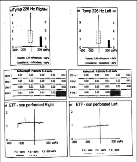 Tympanogram -bilateral B type curve, with severe Eustachian tube... | Download Scientific Diagram