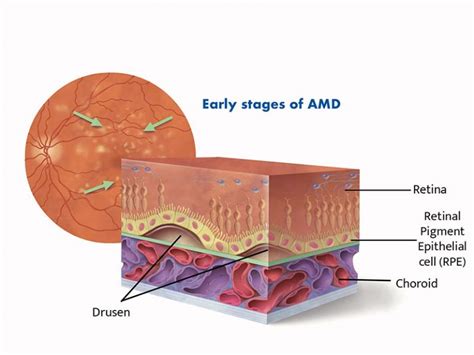 What is Age-Related Macular Degeneration? | Macular Disease Foundation ...