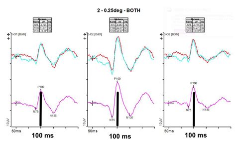 Visually Evoked Potentials (VEP) - Diagnosys LLC