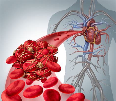 Phlébite - Thrombose veineuse - Causes, symptômes et traitement - Santé-Médecine