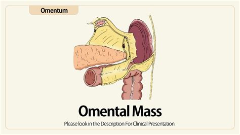 Linear EUS : Omintal Mass - YouTube