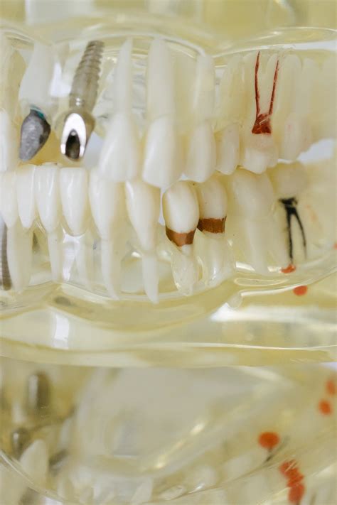 Root Canal (Endodontics) — A-Z Dental