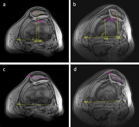 Dynamic measurement of patellar tracking and tilt in a female patient... | Download Scientific ...