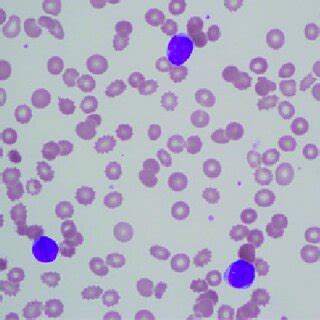 Peripheral blood smear (Wright-Giemsa stain) showing numerous blasts... | Download Scientific ...