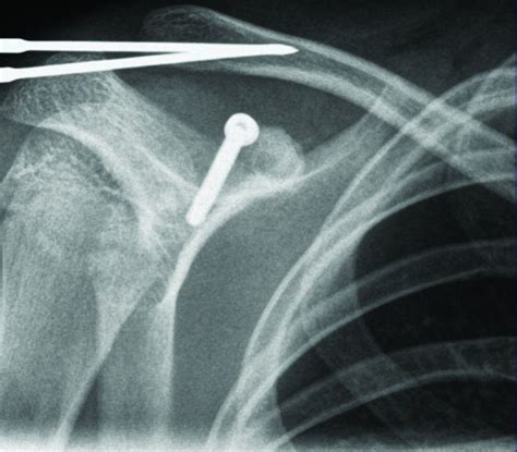 Base of coracoid process fracture with acromioclavicular dislocation in a child | Journal of ...