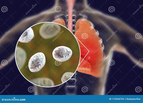 Fungal Pneumonia Concept Icon Cartoon Vector | CartoonDealer.com #232662727