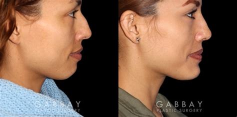 Cleft Chin Plastic Surgery Before And After - Plastic Industry In The World