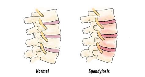 Spondylosis - Symptoms, Causes, Treatment and Rehabilitation