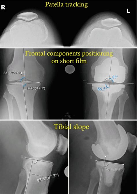 Fig. 28.8, [Short film knee radiographs (skyline,...]. - Personalized ...