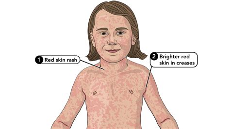 Symptoms of Scarlet Fever | Group A Strep | CDC