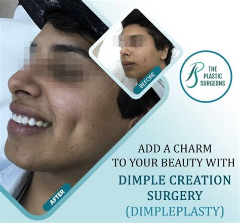 Best Dimple Creation Surgery in Mumbai - Dr. Vinay Jacob