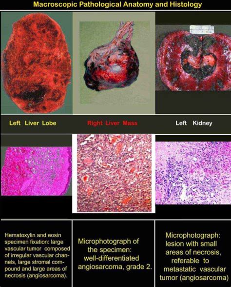 LIVER HEMANGIOSARCOMA: Macroscopic Pathological Anatomy and Histology ...