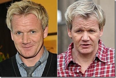 Gordon Ramsay’s Hair Transplant – Worth The Money, Or £30,000 Flushed Down The Drain? | Hair ...