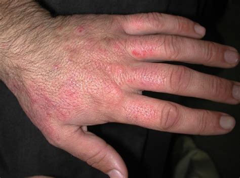 ACD A-Z of Skin - Irritant contact dermatitis (ICD)