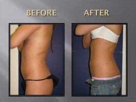 SmartLipo Exposed - How does Smart Lipo Work | Smart lipo, Lipo before and after, Lipo