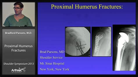 Arthrex - Proximal Humeral Fractures: Pathophysiology and Treatment Options (Presentation 1 of 4)