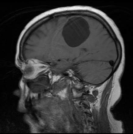 Neuroglial cyst | Image | Radiopaedia.org