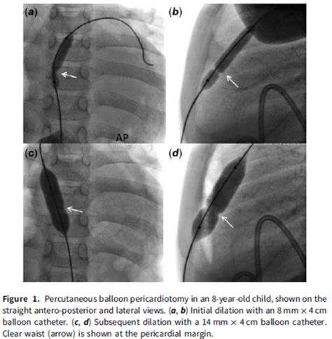 Single center experience of pediatric percutaneous balloon pericardiotomy - Congenital Heart ...