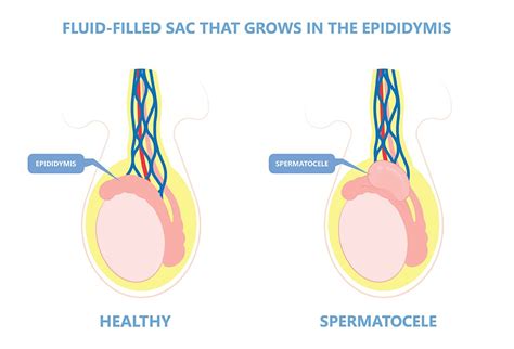 Spermatocele: Symptoms, Causes, and Treatments - Birla Fertility & IVF