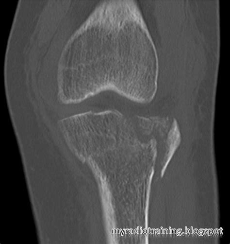 Schatzker Fracture Classification