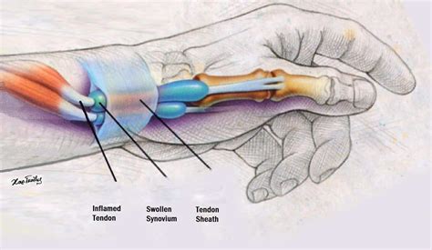 De Quervain's Tenosynovitis Tendons