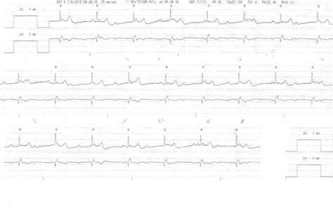 Dr. Smith's ECG Blog: Intermittent third degree heart block due to stuttering inferior STEMI